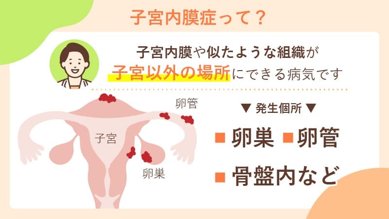 子宮内膜症の症状と検査・治療方法｜かえでレディースクリニック福岡博多