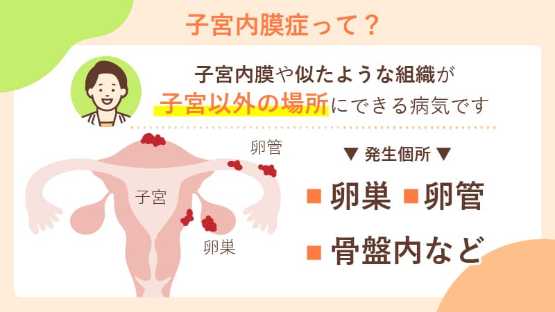子宮内膜症とはどのような病気？
