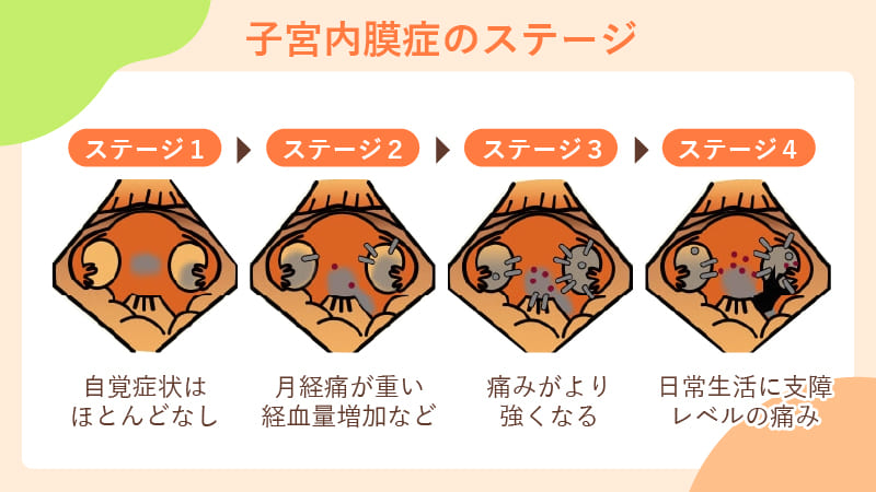 子宮内膜症の4段階のステージの図解